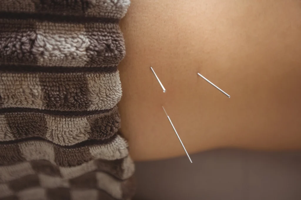 acupuncture for sciatica cost