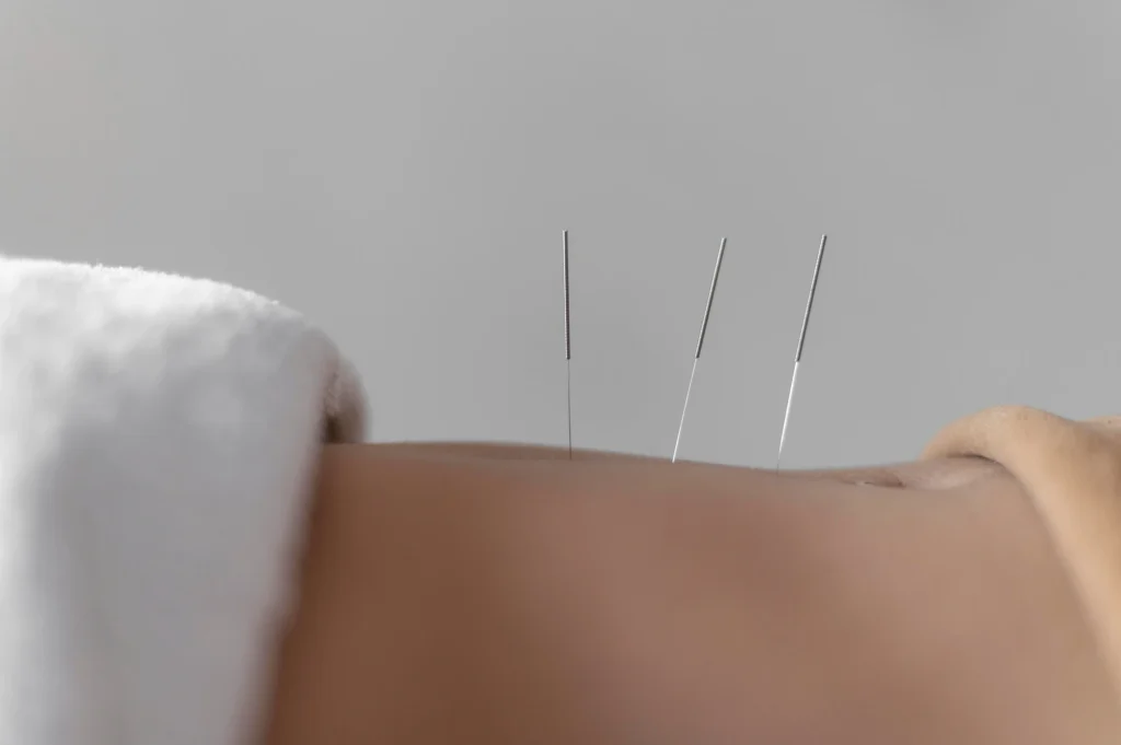 acupuncture logan square