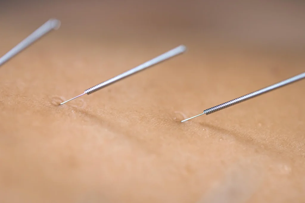 acupuncture in logan square