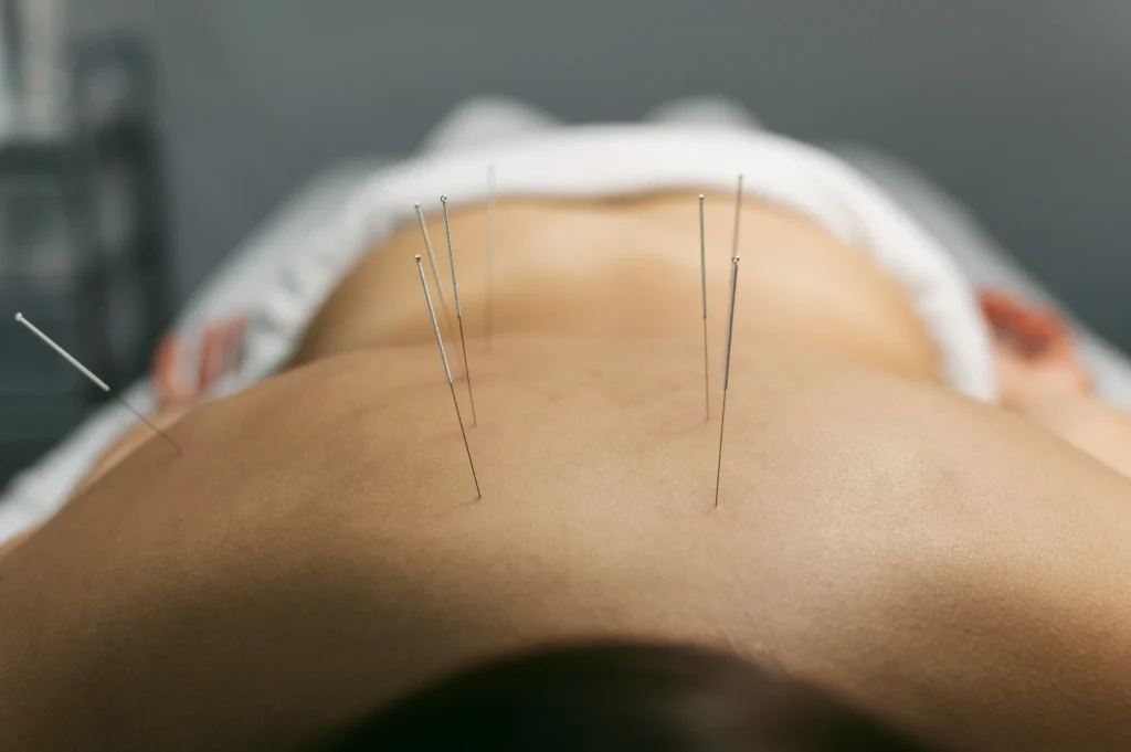 acupuncture near me